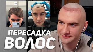 БРАТИШКИН СДЕЛАЛ ПЕРЕСАДКУ ВОЛОС..
